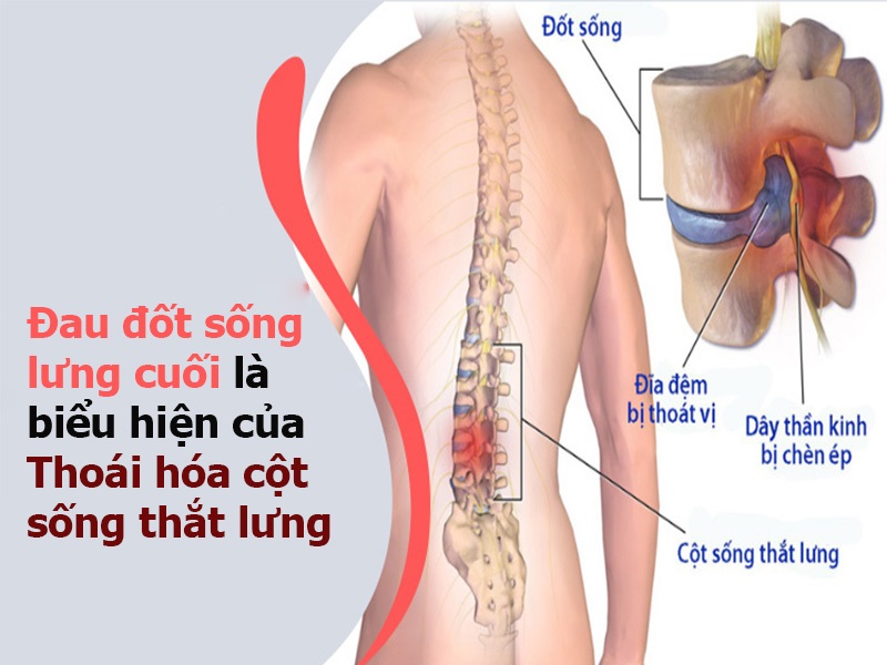 dau-lung-dot-song-cuoi-co-the-la-dau-hieu-canh-bao-thoai-hoa-cot-song-that-lung